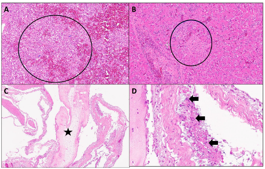Figure 2. Histological findings in a 10-year-old male African grey parrot with avian chlamydiosis (H&E stain).  A. Spleen contains large foci of acute parenchymal necrosis, associated with a mixed cellular infiltrate of macrophages and fewer heterophils (circle).  B.  Liver contains similar foci of necrosis and histiocytic inflammatory infiltrate (circle).  C. & D.  The pericardial cavity is filled with fibrino-cellular exudate (star) and numerous macrophages that are distended by densely-aggregated, fine granular pale basophilic cytoplasmic bacterial colonies (arrows).