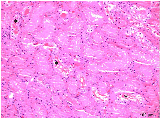 Figure 2. Microscopic section of kidney (H&E, 20x) demonstrating luminal accumulation of granular red-pink pigment in renal tubules (*).