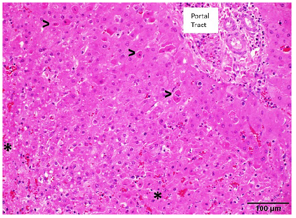 Figure 3. Microscopic section of liver (H&E, 20x) demonstrating periacinar to mid-zonal hepatocellular degeneration (*) and single cell death among periportal hepatocytes (>).  