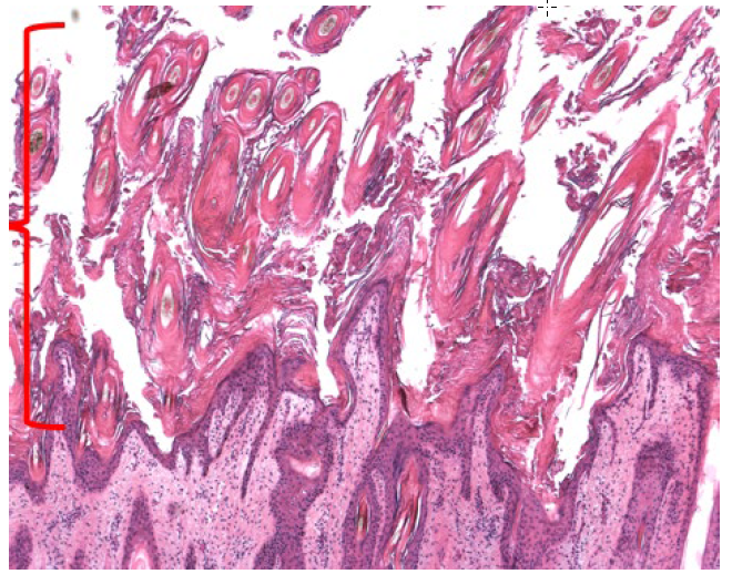 Figure 2. Massively thick layer of hyperkeratotic debris at epidermal surface of haired skin in a bovine neonate with vitamin A deficiency (red bracket).  H&E stain.