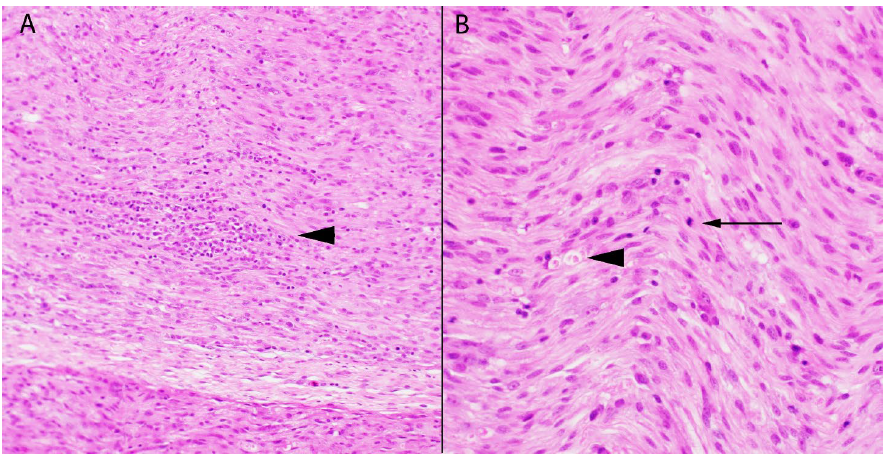 Figure 2. Lesions in the peripheral nerves associated with riboflavin deficiency (H&E stain). A. Mononuclear cell infiltrates (arrowhead). B. Schwann cell hyperplasia and hypertrophy, with mitotic figure (arrow), and axon degeneration (arrowhead).