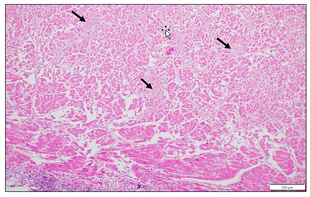  A photomicrograph of the fetal heart showing areas of fibrosis (arrows) and lymphocytic inflammation in the epicardium (bottom left). H&E stain, 400X.