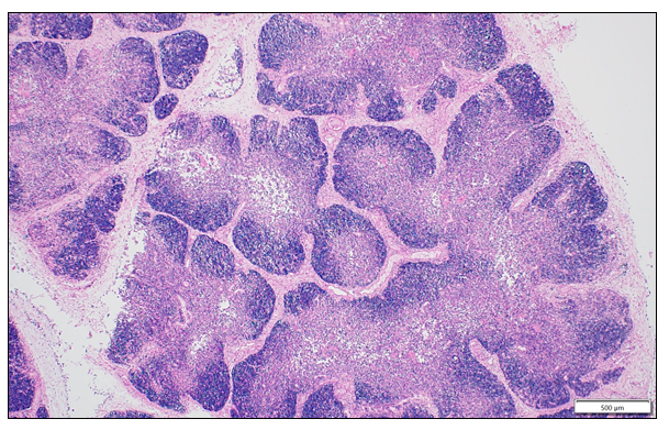  A photomicrograph of the fetal thymus showing significant reduction in the lymphocyte population (blue areas) with a relative increase in the medullary tissue (pink areas). H&E stain, 200X.