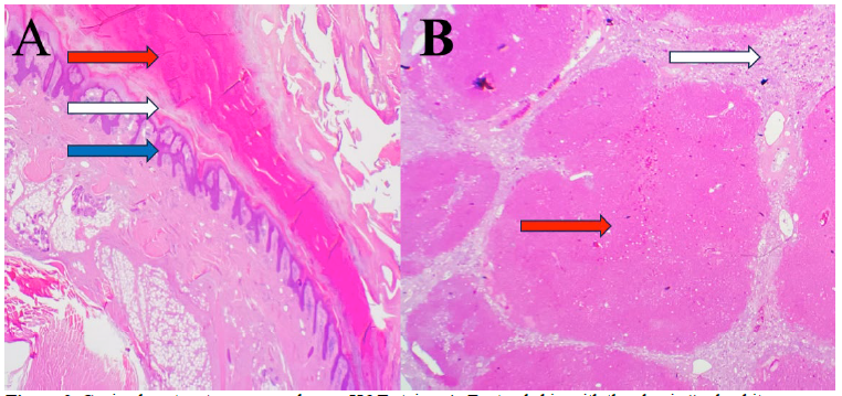 Figure 2. Canine hepatocutaneous syndrome. H&E stains. A. Footpad skin with the classic “red, white and blue” lesions of superficial necrolytic dermatitis.  Thick parakeratotic hyperkeratosis (red arrow), ballooning degeneration, epithelial necrolysis and spongiosis of the epithelium (white arrow), and the hyperplastic epithelial basal layer (blue arrow). H&E stain, 2x. B. Severe bridging hepatic fibrosis and parenchymal collapse (white arrow) with multinodular hepatocellular regeneration (red arrow). H&E stain, 2x.