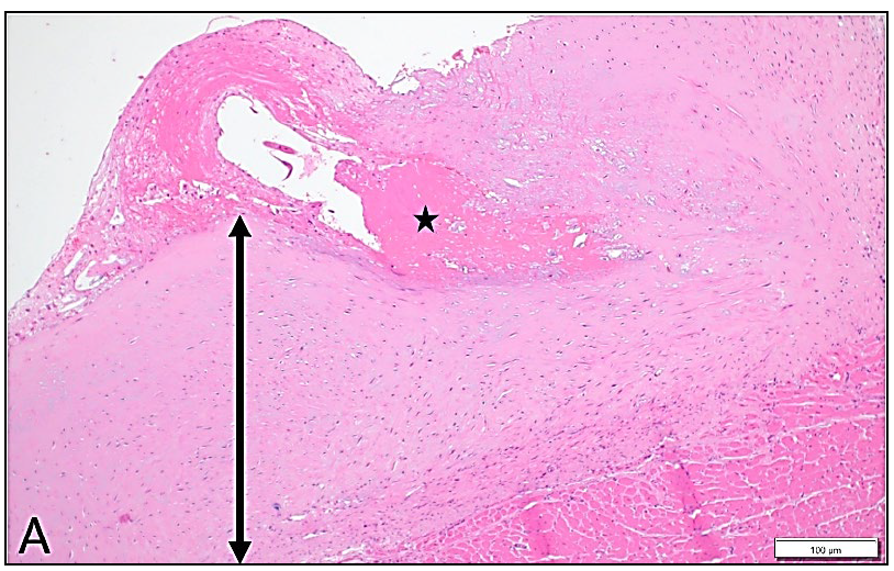  The thickness of the endocardium of the right ventricle (arrowheads) from the same cat. H&E stain.