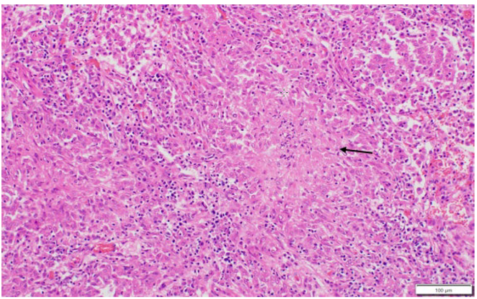Figure 2. Histologic lesions of M. bovis granulomatous pneumonia in a cat.  Alveoli are infiltrated and normal pulmonary architecture is obscured by large numbers of densely packed macrophages intermingled with fewer lymphocytes and neutrophils, and small necrotic foci (arrow) (H&E stain).  
