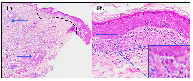  Histiocytes containing a fine dusting of melanin granules (blue arrows) (40x). 