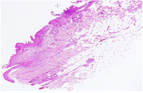 Figure 2. Overview of a sample of the skin with extensive ulceration of the surface,  covered by a thick crust.