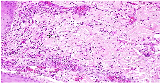 Figure 3. Neutrophilic inflammation of the dermis, centered on small blood vessels.