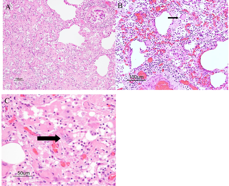 Figure 1. Histologic lesions in donkey lung compatible with interstitial fibrosing pneumonia. H&E stains. A. Massive expansion of the alveolar interstitium by dense collagen bundles (fibrosis) that compress adjacent alveoli. 10x. B. Bronchiolar epithelium is denuded, and airspaces contain numerous macrophages, lymphocytes, fewer neutrophils and large multinucleate cells (arrow). 20x. C. Syncytial cell (arrow) within a bronchiole. 40x.