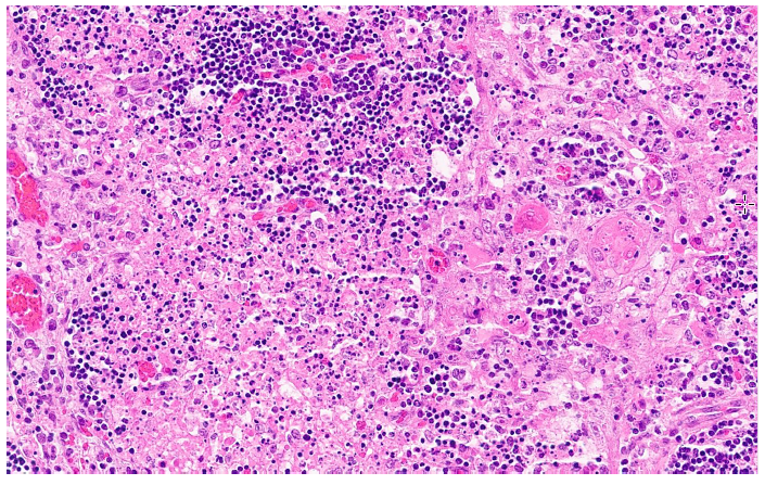 Figure 1. Histological findings in an aborted fetus infected with non-neuropathogenic equine herpesvirus-1. Thymus with foci of acute fibrinous necrosis, lymphocyte karyorrhexis and acute interstitial hemorrhage. H&E stain.