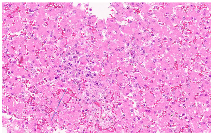 Figure 3. Histological findings in an aborted fetus infected with non-neuropathogenic equine herpesvirus-1. The liver contains few small foci of acute hepatocellular degeneration with loose infiltrates of macrophages, fewer lymphocytes, and rare neutrophils (arrow). H&E stain.