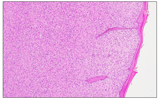 Figure 1. Feline, skin. A mesenchymal mass composed of densely-arranged spindle cells in a fine collagenous matrix. There are few elongate rete pegs in the epidermis. H&E stain.