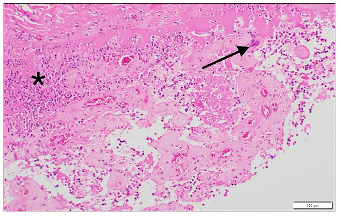 Figure 1. The synovial surface forms papillary projections covered with fibrin and neutrophils (*) mixed with occasional small clusters of bacteria (arrow). H&E stain.