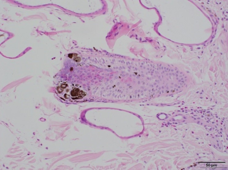 Hair follicle with abnormal pigment distribution and mural lymphocytes. H&E, 20X.