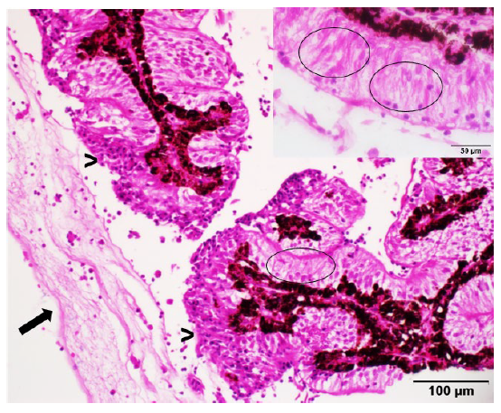  Hypereosinophilic linear inclusions in the cytoplasm of non-pigmented ciliary body epithelium.