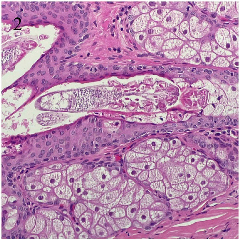 Figure 2. Equine Demodex. H&E stain. Demodex mite in cross-section within a duct of the sebaceous (meibomian) glands of the eyelid. 40x. 