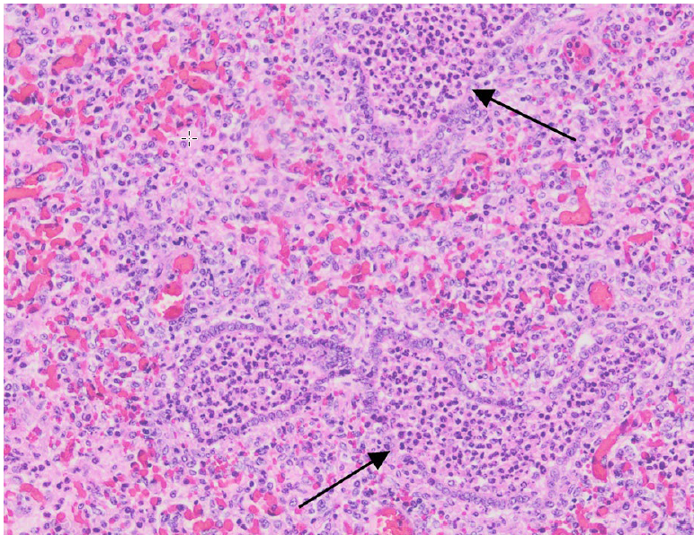 Figure 1.  Porcine lung with lesions of suppurative bronchointerstitial pneumonia.  Bronchioles and adjacent alveoli contain large numbers of neutrophils, and there is patchy attenuation and loss of bronchiolar epithelium (black arrows).  (H&E stain)