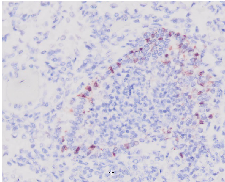 Figure 2.  Porcine lung with positive (brown) cytoplasmic staining of bronchiolar epithelial cells lining affected bronchioles.  (Influenza A immunohistochemical stain)