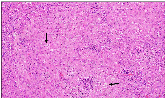 Figure 1. Pyogranuloma in the lung containing numerous fungal organisms (arrows). Hematoxylin and eosin stain, 400X magnification. 
