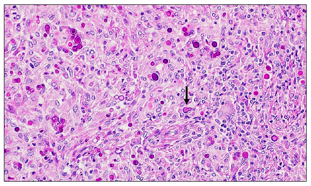 Figure 2. Multiple yeast organisms surrounded by pyogranulomatous inflammation and fibrous tissue making up the intra-abdominal mass. Broad-based budding is captured in section (arrow). PAS stain, 400X magnification. 