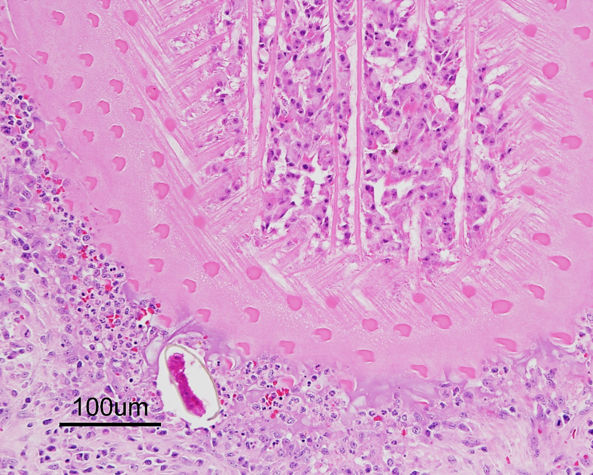 Figure 1. Histologic view of part of an adult fluke within the bronchiole of an infected dog, showing the thick outer eosinophilic tegument with short spines, and subtegmental musculature. A partially-ruptured, yellow-brown operculate egg is free within the adjacent inflammatory cell debris within the lumen of the bronchiole.  This dog developed spontaneous pneumothorax, and a lung lobectomy was performed and submitted for histology. H&E stain.   