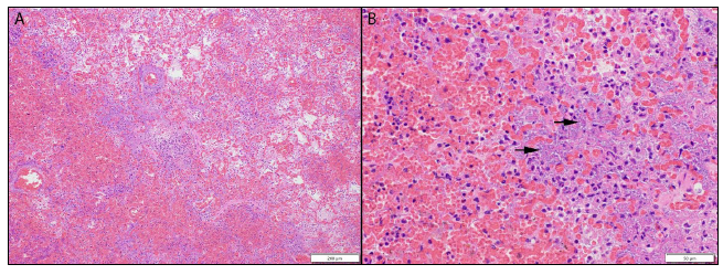 Figure 1. A. Acute severe hemorrhagic pneumonia in mink due to Pseudomonas aeruginosa. B. Note the widespread hemorrhage in the lung tissue and numerous bacteria (arrows).