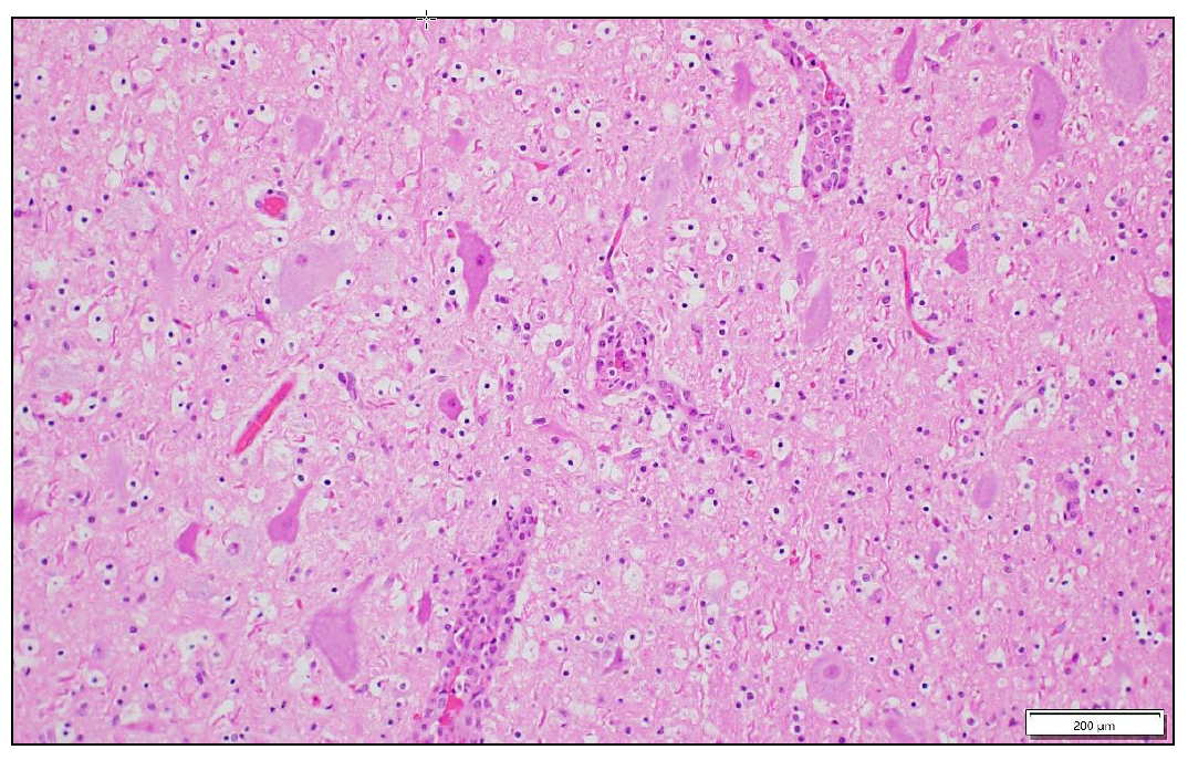 Figure 2. Multiple vessels in the brainstem with large cuffs of lymphocytes, macrophages,                    and fewer neutrophils. H&E stain. 