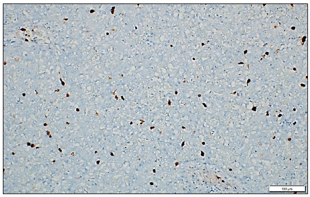  Section of liver showing numerous hepatocytes with strong positive immunoreactivity for adenovirus (brown pigment). DAB chromogen.