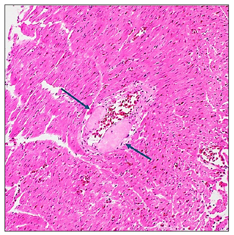  A myocardial vessel with multifocal distortion and thickening of the wall  by brightly eosinophilic (pink) deposition of amyloid (arrows). H&E stain, 20x.