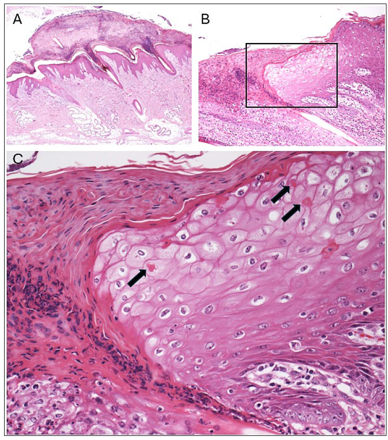 Figure 2. Histologic lesions of swinepox in haired skin from a neonatal piglet. (A) Discrete focus of epidermal hyperplasia covered by a thick cellular crust. (B) Epithelial cell swelling (hydropic degeneration) in epidermis at the periphery of the skin lesion. (C) Inset from panel B – Eosinophilic intracytoplasmic viral inclusions in swollen epithelial cells. H&E stain.