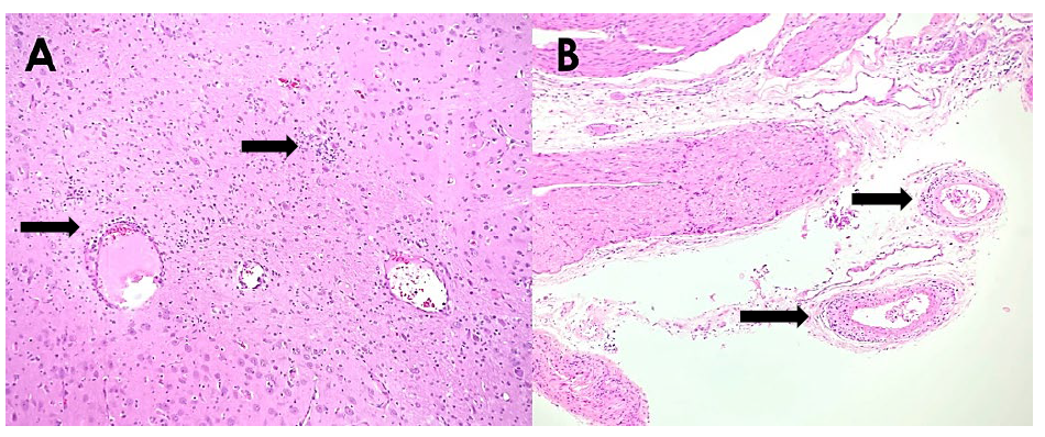 Figure 1. Histological lesions of PCV3 infection in piglets (H&E stain).  A. Lymphoplasmacytic encephalitis of the midbrain (arrows).  B. Arteries within the leptomeninges of the spinal cord infiltrated or cuffed by plasma cells and lymphocytes (arrows). 
