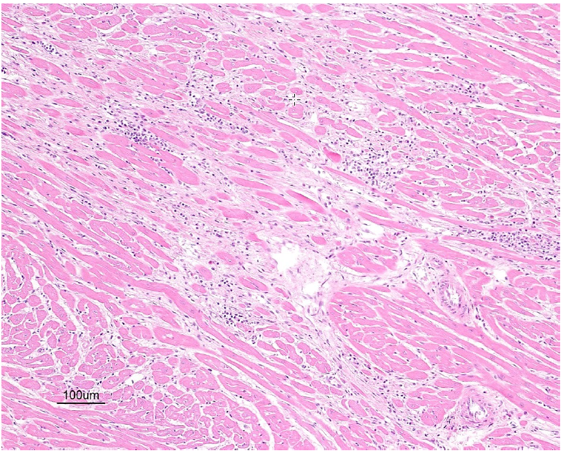 Figure 2. Myocardium of puppy number two, H & E stain, 10X.  Note extensive fibrosis,  nonsuppurative inflammatory infiltrates, and loss of cardiomyocytes.