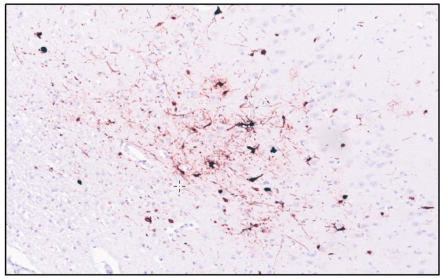 Figure 3. Brain (hippocampus) from a 14-week-old puppy.  Clusters of neuronal cell bodies and nerve processes are intensely positive for expression of the canine distemper virus antigen (IHC stain canine distemper virus, 20x)