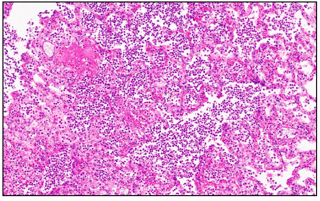 Figure 1. Lung from a 14-week-old puppy.  There is necrosis of alveolar walls with fibrin deposition and numerous macrophages and degenerate neutrophils (H&E stain, 10x)