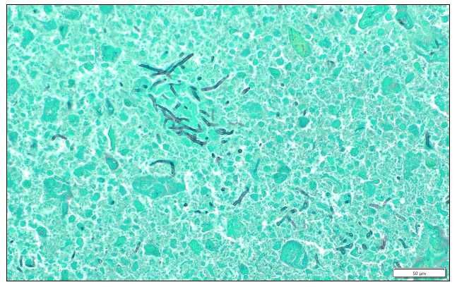 Figure 1. Placental necrosis with numerous fungal hyphae stained black. GMS stain.
