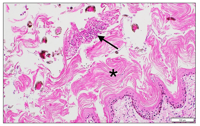 Figure 2. Excess lamellar keratin on the epidermal surface of the eyelid (*) with a pustule (arrow).
