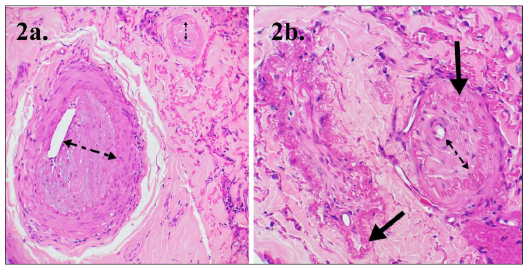 Figure 2. Histologic features of proliferative arteritis of the dermal arteries/arterioles of the nasal philtrum. a. Marked narrowing of the lumen and thickening of the wall of dermal arteries and arterioles with matrix deposition in the tunica intima and subendothelial spindle cell proliferation (dashed arrows) 20x. b. Highly irregular undulating internal elastic lamina (solid arrows) 20x. H&E stain.