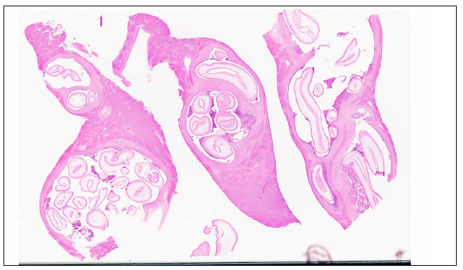 Figure 4. Histological findings in a Kunekune piglet with hepatobiliary ascariasis. There is widespread biliary ductular dilation with luminal spaces filled with innumerable cross, tangential, and longitudinal sections of adult nematode parasites. H&E stain.