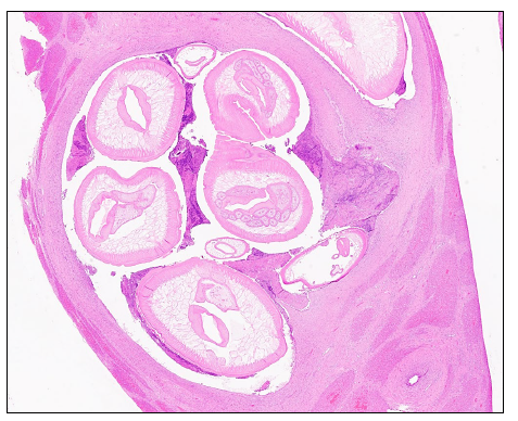Figure 5. Histological findings in a Kunekune piglet with hepatobiliary ascariasis. Nematodes contain morphological features consistent with an ascarid nematode, and are associated with both luminal debris/exudate and mural inflammation. H&E stain.