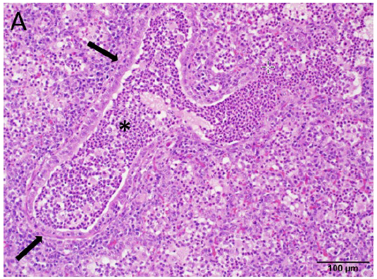 Figure 2.  Nursing pig.  Microscopic section of lung (H&E stain, 4x).  Affected lobules on the right half of the image correspond to the grossly noted areas of lobular atelectasis, and multiple small airways contain luminal accumulation of neutrophils (*), accompanied by mild alveolar edema with variable accumulation of macrophages and neutrophils. 