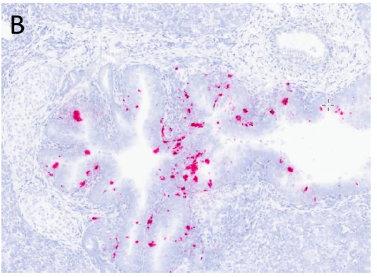 Figure 3.  Nursing pig.  Microscopic sections of lung (H&E stain, 20x).  A. Bronchiolar epithelial attenuation (arrows) with luminal accumulation of suppurative exudate (*), as well as accumulation of neutrophils and macrophages in adjacent alveoli.  B. RNA in situ hybridization assay demonstrating moderate staining for PoASTV4 in bronchial epithelium. (Photo courtesy of Dr. Derscheid, Iowa State Veterinary Diagnostic Laboratory).