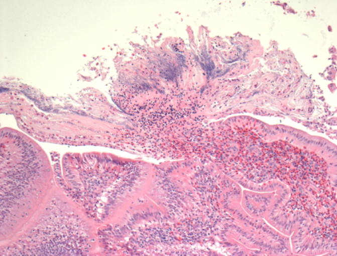 Histology of FDN.  Focal necrosis of villus tips with luminal effusion of proteinaceous fluid and heterophils accompanied by large numbers of slender filamentous bacteria.