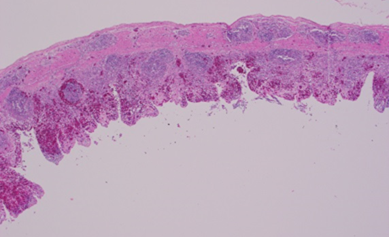 mall intestine annular bands showing mucosal hemorrhage and lymphoid necrosis. H&E.