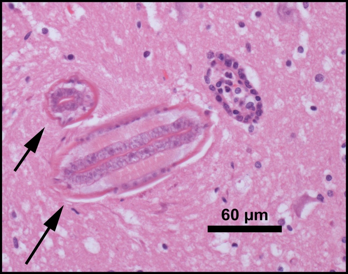 Baylisascaris procyonis larvae (arrows) migrating in cerebral cortical white matter. H&E.