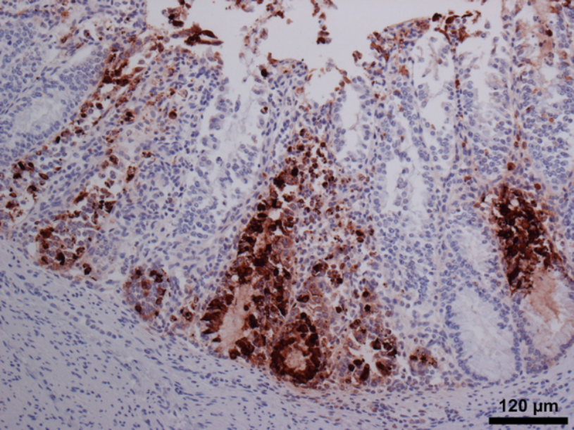 Strong positive IHC staining for bovine coronavirus antigen in colon from a calf that was BCV PCR negative, showing the value of using more than one test for diagnostic evaluation.