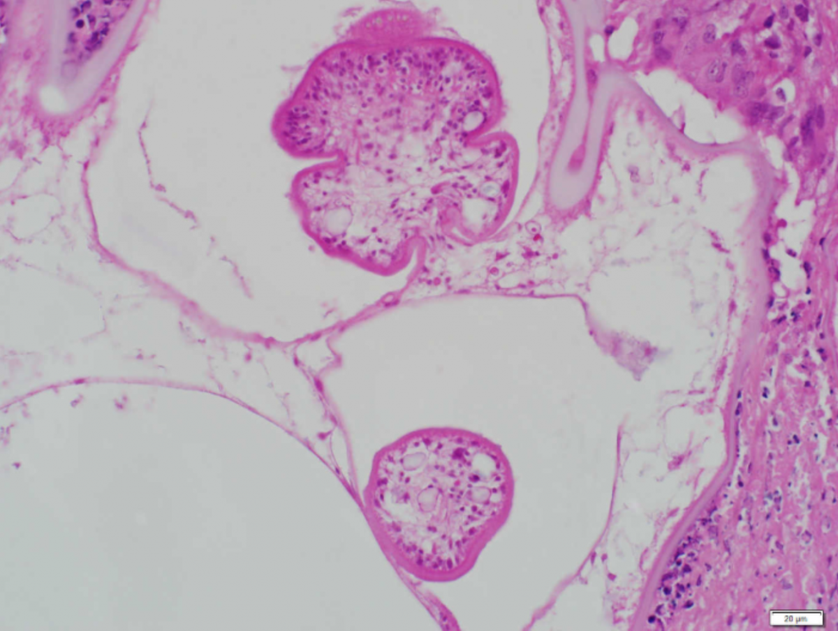 Histology from the wall of one of the resected masses, with two protoscolices from encysted tapeworms (H&E, 400x magnification).