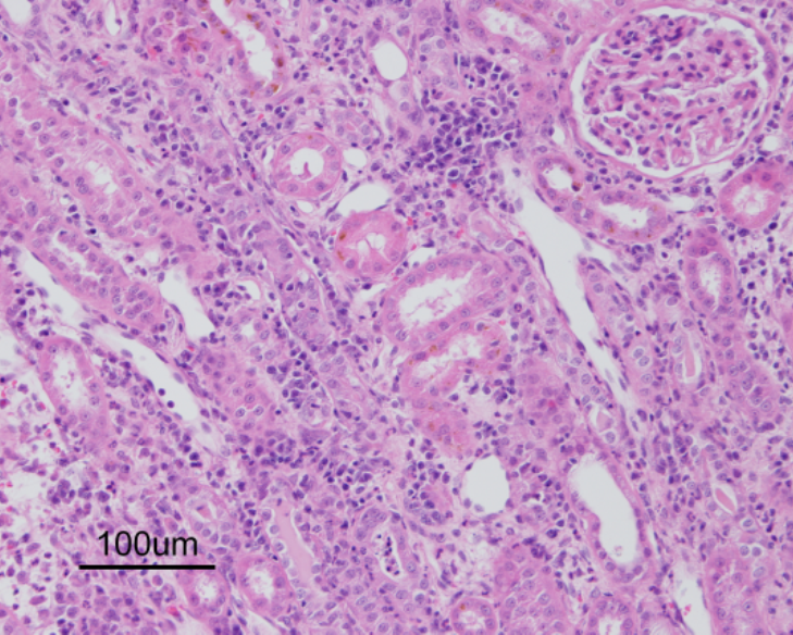 Lymphoplasmacytic, histiocytic and suppurative tubulointerstitial nephritis in a dog (H&E).