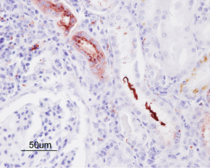 Positive immunostaining for Leptospira interrogans in tubular lumens, tubular epithelial cells and interstitial macrophages.