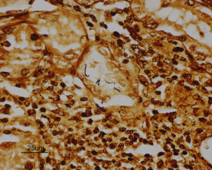 Aggregates of typical curving spirochete bacteria in tubular lumens (GMS silver stain).